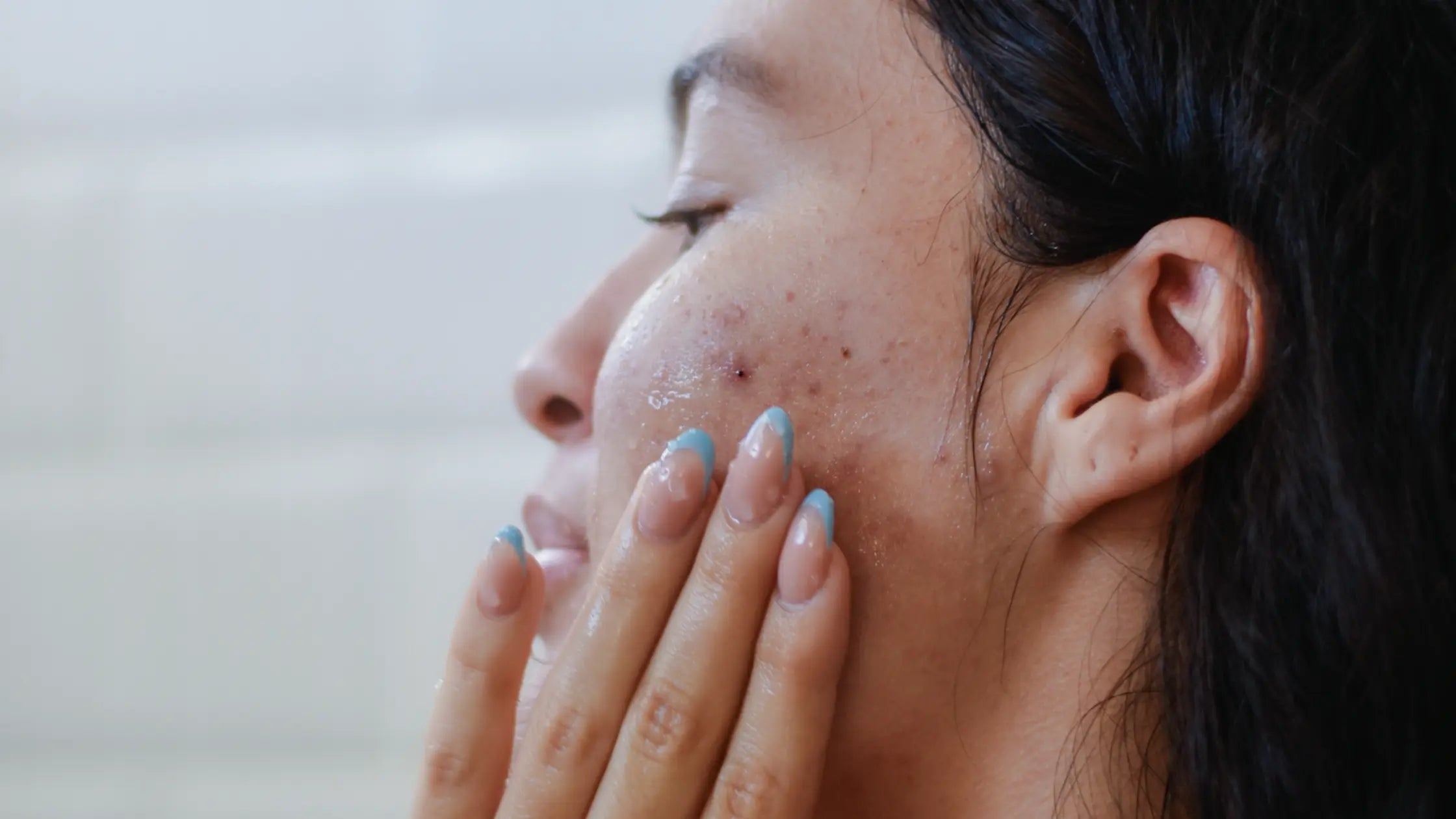 The Real Reasons Your Skin Breaks Out